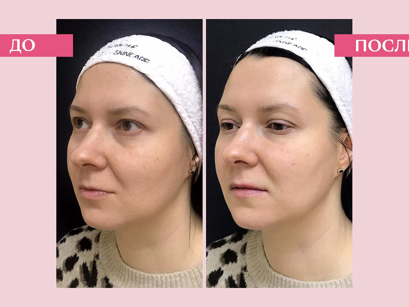 Как редактор Glamour впервые решилась на филлеры