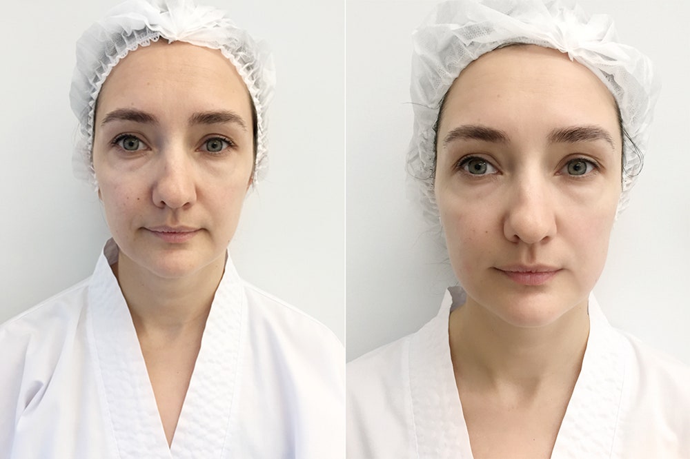 Тестклуб Glamour какие аппаратные процедуры для лица помогут выглядеть моложе