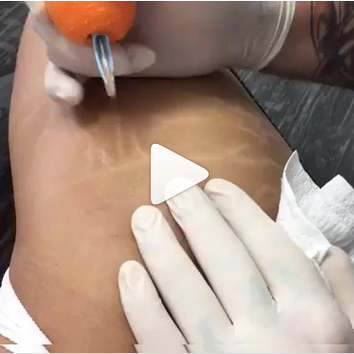 Бразильский тату-мастер убирает растяжки при помощи телесной татуировки