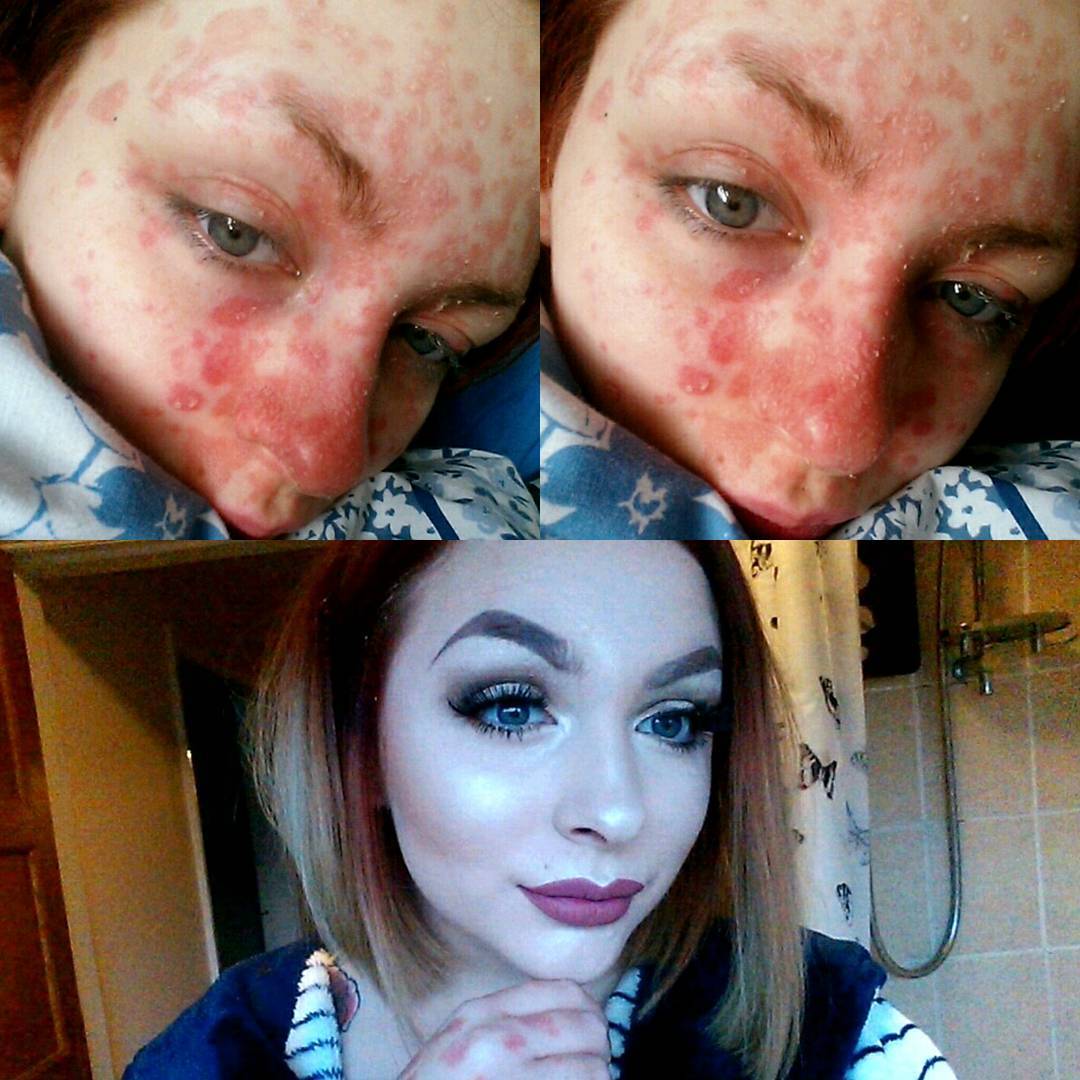 Бьютиблогера Софию Ридлингтон страдающую псориазом бросил парень увидев ее без макияжа