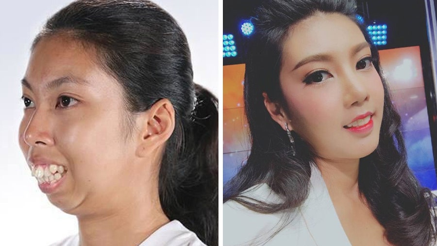 Корейские пластические хирурги исправили девушке деформацию челюсти фото до и после | Glamour