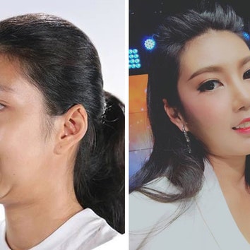Чудеса корейской пластики: девушку со страшной челюстью превратили в красавицу
