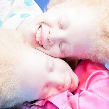 Темнокожие близнецы-альбиносы стали звездами интернета