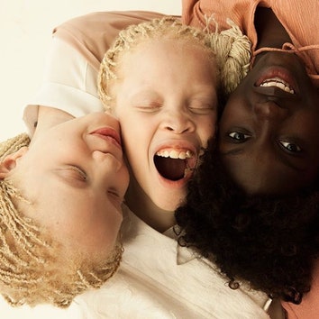 Темнокожие близнецы-альбиносы стали звездами интернета