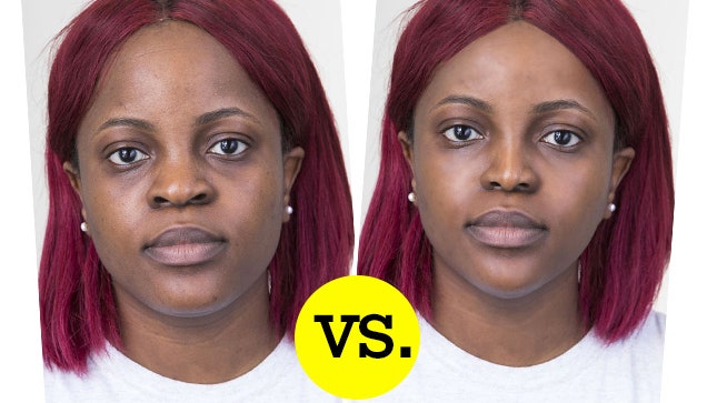 Ринопластика фото до и после в клинике 