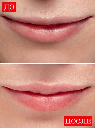 Чтобы выделить контур и придать объем центральной части верхней губы в нее сделали четыре укола Restylane Lip Volume ...