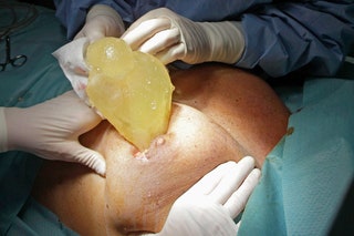 Январь 2012 год. Французский хирург Денис Бюк извлекает из груди пациентки имплантаты PIP.